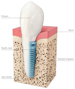 Dental Implants | Alchemy Dental Practice