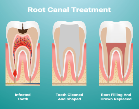 Endodontics | Alchemy Dental Practice